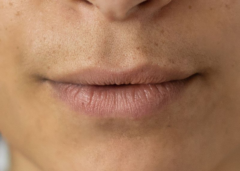 Gesichtssaethetik-lippen Gesichtssaethetik-lippen