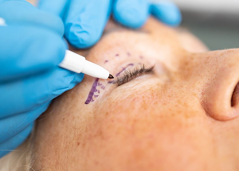 Eyelid Lift Eyelid Lift