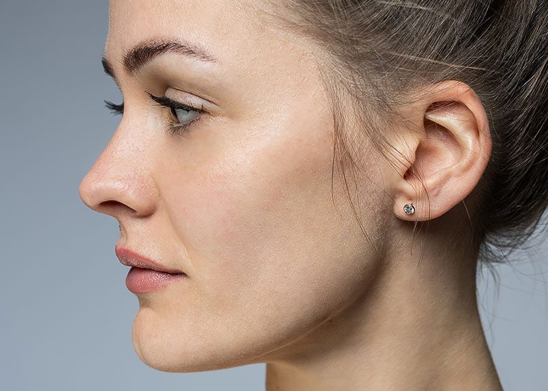 Defining the chin-jaw line at the practice clinic of Dr. Million, Oldenburg Jawline-Gesichtsaesthetik