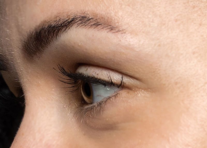 Brauenlift in der Praxisklinik Dr. Million, Oldenburg brow-lift